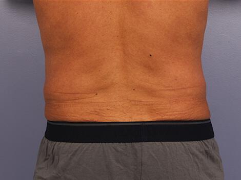 CoolSculpting Gallery Before & After Image