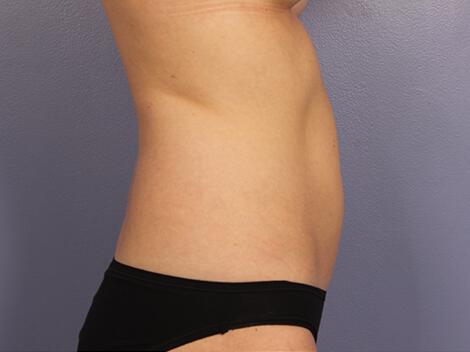 CoolSculpting Gallery Before & After Image