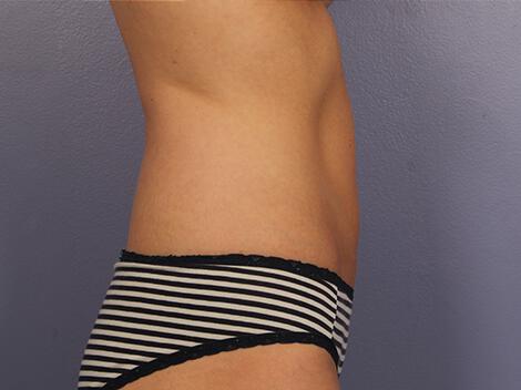 CoolSculpting Gallery Before & After Image