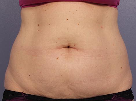 CoolSculpting Gallery Before & After Image