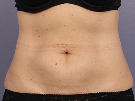 CoolSculpting Gallery Before & After Image