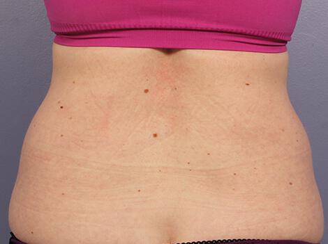 CoolSculpting Gallery Before & After Image