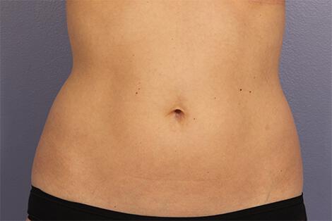 CoolSculpting Gallery Before & After Image