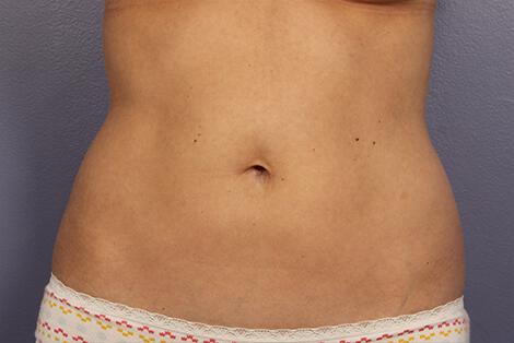 CoolSculpting Gallery Before & After Image