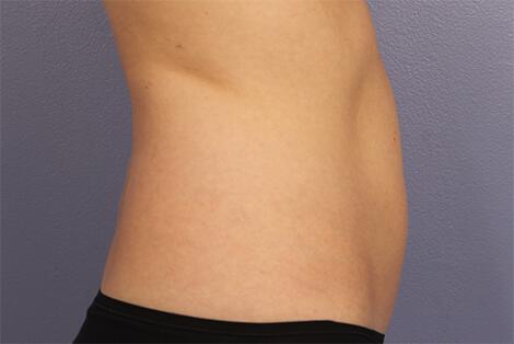 CoolSculpting Gallery Before & After Image