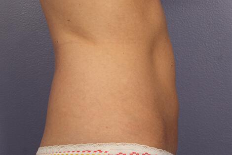 CoolSculpting Gallery Before & After Image