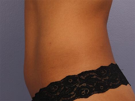 CoolSculpting Gallery Before & After Image