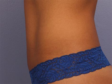 CoolSculpting Gallery Before & After Image