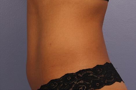 CoolSculpting Gallery Before & After Image