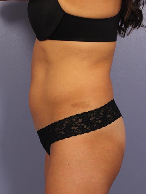 CoolSculpting Gallery Before & After Image