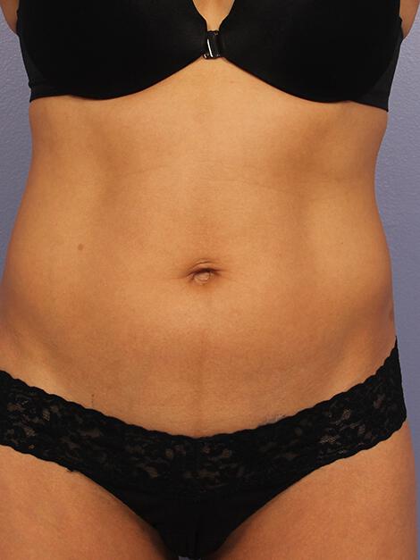 CoolSculpting Gallery Before & After Image