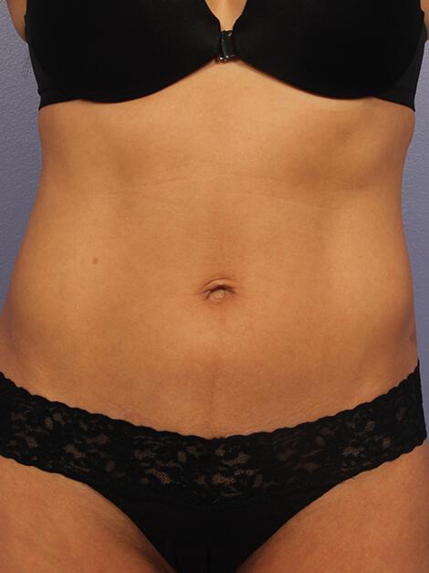 CoolSculpting Gallery Before & After Image