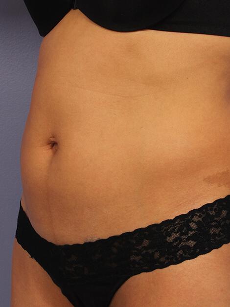 CoolSculpting Gallery Before & After Image