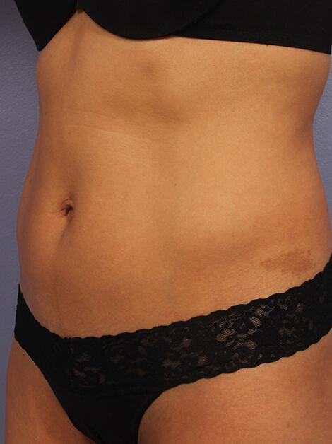 CoolSculpting Gallery Before & After Image