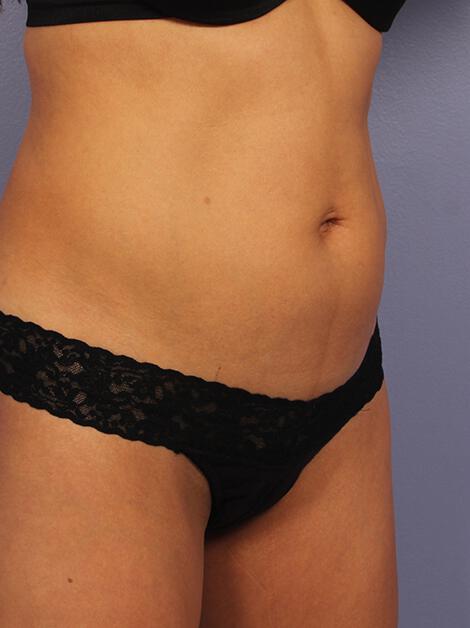 CoolSculpting Gallery Before & After Image