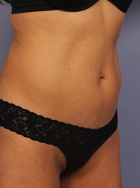 CoolSculpting Gallery Before & After Image