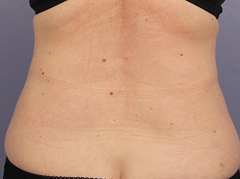 CoolSculpting Gallery Before & After Image