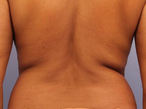 CoolSculpting Gallery Before & After Image