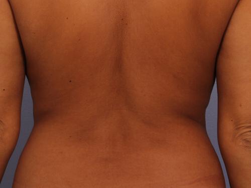 CoolSculpting Gallery Before & After Image