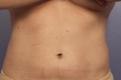 CoolSculpting Gallery Before & After Image