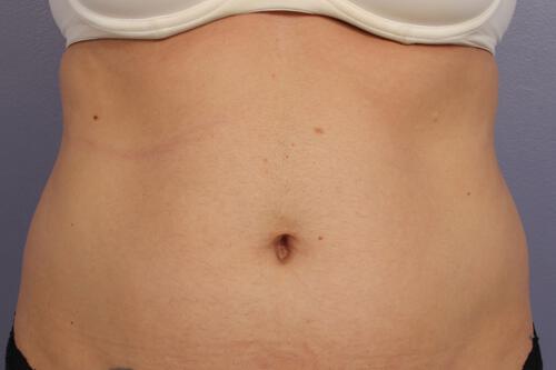 CoolSculpting Gallery Before & After Image