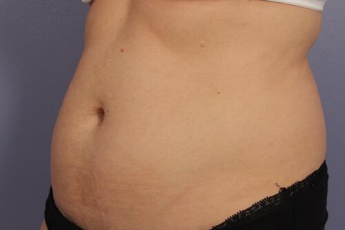 CoolSculpting Gallery Before & After Image