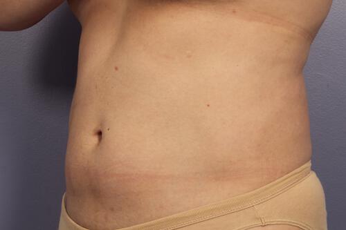 CoolSculpting Gallery Before & After Image