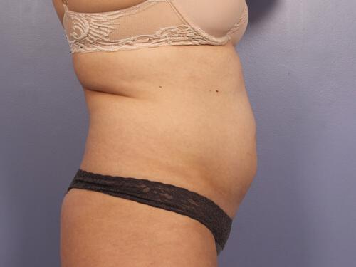 CoolSculpting Gallery Before & After Image