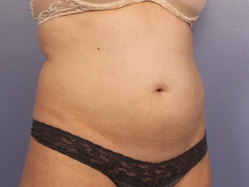 CoolSculpting Gallery Before & After Image