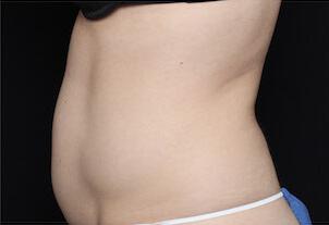 Fat Reduction Gallery Before & After Image