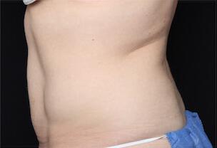 Fat Reduction Gallery Before & After Image