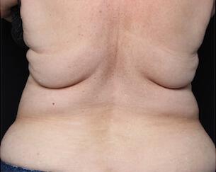 Fat Reduction Gallery Before & After Image