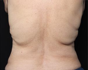 Fat Reduction Gallery Before & After Image