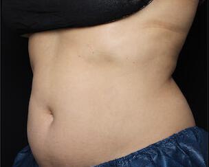 Fat Reduction Gallery Before & After Image