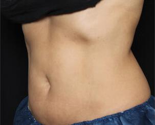 Fat Reduction Gallery Before & After Image