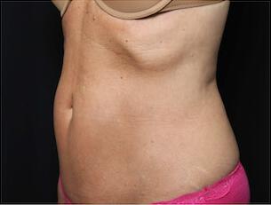 Fat Reduction Gallery Before & After Image