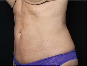 Fat Reduction Gallery Before & After Image