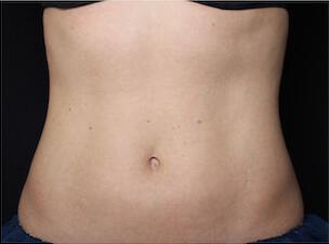 Fat Reduction Gallery Before & After Image