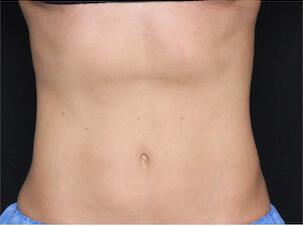 Fat Reduction Gallery Before & After Image