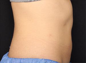 Fat Reduction Gallery Before & After Image