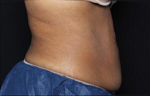 Fat Reduction Gallery Before & After Image