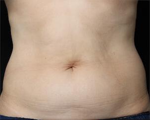 Fat Reduction Gallery Before & After Image