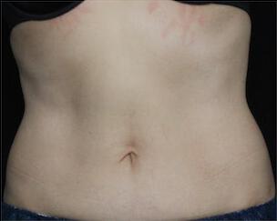 Fat Reduction Gallery Before & After Image