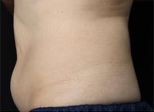 Fat Reduction Gallery Before & After Image