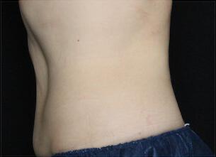 Fat Reduction Gallery Before & After Image