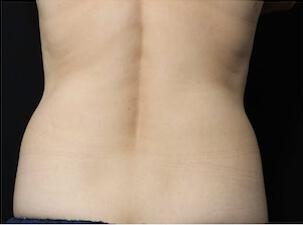 Fat Reduction Gallery Before & After Image