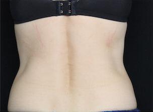 Fat Reduction Gallery Before & After Image