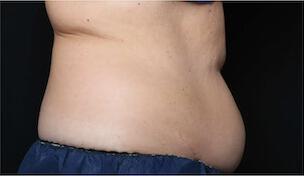 Fat Reduction Gallery Before & After Image