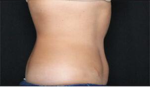 Fat Reduction Gallery Before & After Image