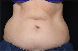 Fat Reduction Gallery Before & After Image